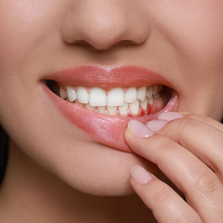 DentalHealthLabs Gingivitis und Parodontitis Zahnfleischentzündungen durch Bakterien auf Zahnbürsten